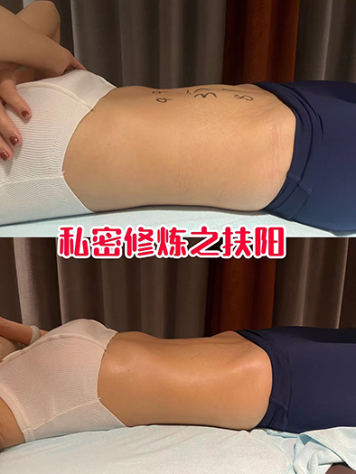 扶阳大肚腩消除术